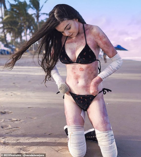 "좌절 마세요" 희귀 피부질환 앓는 20대 브라질 女모델의 응원