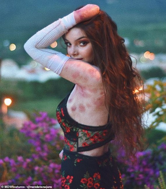 "좌절 마세요" 희귀 피부질환 앓는 20대 브라질 女모델의 응원