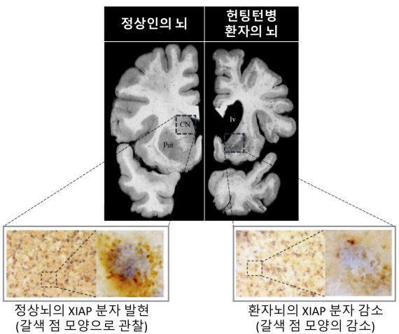 정상인의 뇌와 헌팅턴병 환자의 뇌에서 'XIAP' 단백질이 생기는 정도가 뚜렷하게 차이가 난다. 'XIAP' 단백질을 면역조직화학법으로 염색해 갈색으로 관찰 할 수 있게 처리했다. 헌팅턴 환자의 뇌에서 'XIAP' 단백질이 생겨나는 것이 적음을 확인할 수 있다. KIST 제공