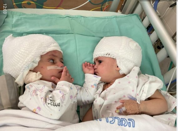 이스라엘에서 뒤통수가 붙은 채로 태어난 샴쌍둥이 자매가 분리수술을 받은 뒤 서로를 마주 보고 있다. /사진=로이터뉴스1