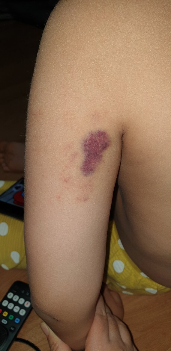 초등학교 1학년 아이의 팔에 피멍이 선명한 모습© 뉴스1