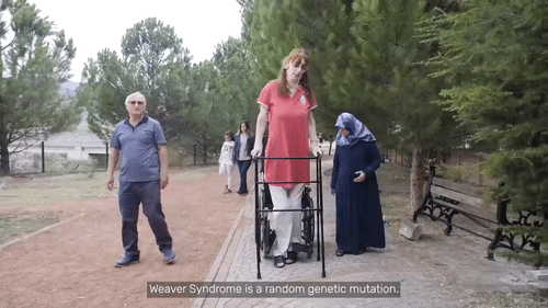 세계에서 가장 키 큰 터키女, 앓고 있는 병명이..