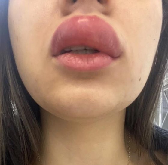 지네에게 물려 입술이 퉁퉁부어 오른 20대 브라질 여성 나탈리 갈디노. 나탈리는 지네 독으로 호흡 곤란까지 생겨 병원에서 입원치료까지 받았다. /사진=트위터