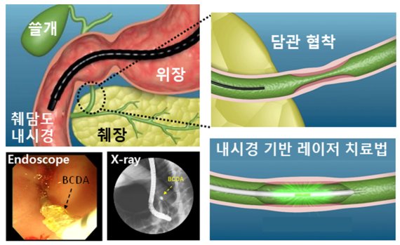 광 전달기기(BCDA)를 이용한 내시경 기반 레이저 치료법 표현 이미지.