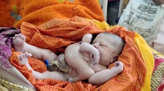 팔·다리 4개인 인도 아기 '충격'...가족들이 의사 고소하려는 이유는?