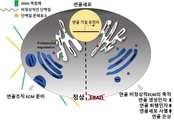 연골 퇴행성 손상 원인, 노화가 다가 아니다