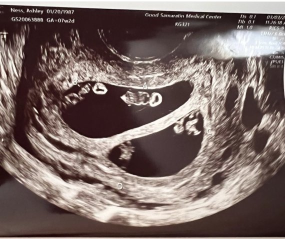 [서울=뉴시스] 미국 매사추세추주에 사는 애슐리 네드는 한 번에 2쌍의 쌍둥이를 임신했다는 소식을 듣고 매우 큰 충격을 받았다. 사진은 그의 초음파 사진. (사진=애슐리 네드 인스타그램 캡처) 2022.06.30. *재판매 및 DB 금지