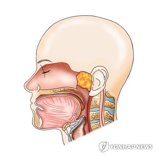 두경부암 /사진=연합뉴스