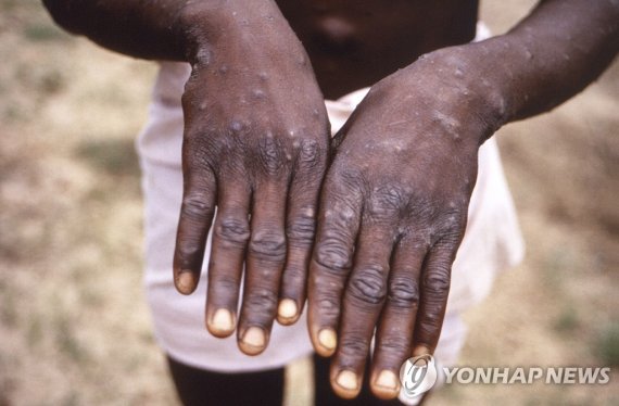 FILE - This 1997 image provided by the CDC during an investigation into an outbreak of monkeypox, which took place in the Democratic Republic of the Congo (DRC), formerly Zaire, and depicts the dorsal surfaces of the hands of a monkeypox case patient, who was displaying the appearance of the charact