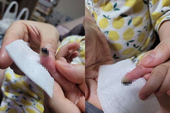 봉합수술을 받았지만 괴사가 온 아이의 손가락. (온라인 커뮤니티 갈무리) © 뉴스1