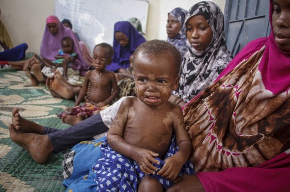 [모가디슈=AP/뉴시스] 지난 5일(현지시간) 소말리아 모가디슈에 있는 기아대응행동(ACH)이 운영하는 영양실조안정센터에 심각한 단백열량부족증인 콰시오커(Kwashiorkor) 증상을 보이는 아이들이 진료를 기다리고 있다. 자료에 따르면 수십 년 만에 최악의 가뭄으로 소말리아에서 올해 450명 가까운 사망자가 발생한 것으로 나타났다. 2022.06.08.