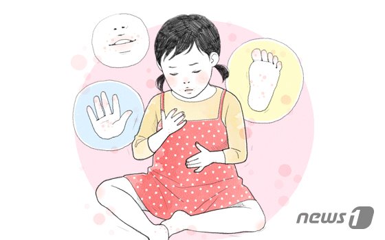 울산시, 영유아 수족구병 ‘주의’ 당부... 올해 증가 추세