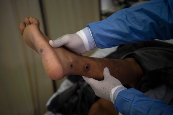 원숭이두창 환자에게 발생하는 검붉은 반점을 들어보이고 있는 페루 의료진 /AFP=연합뉴스