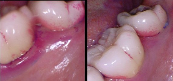 2월 3일 하악좌측 제1대구치 설면 모습(왼쪽)과 3월 4일 같은 치아의 치석 비교 모습. 보라색 치석염색제가 염색된 곳이 적어진 것을 확인할 수 있다. ⓒ 뉴스1 신윤하 기자