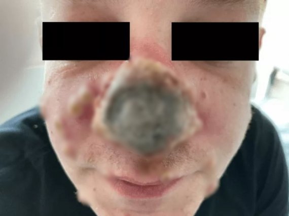원숭이두창에 걸려 코가 괴사된 40대 독일 남성. (스프링거 링크 제공)