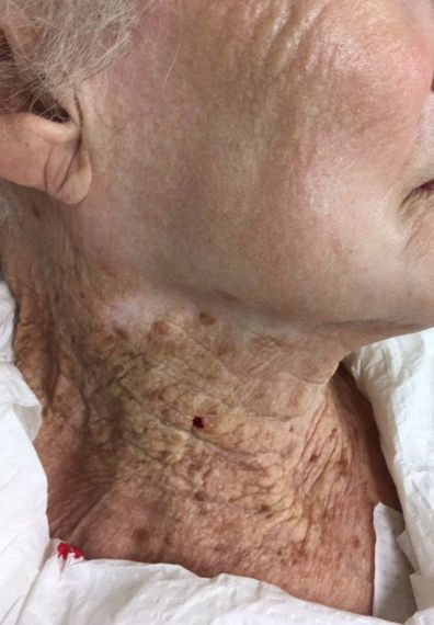 40년간 얼굴에만 선크림을 바른 90대 여성의 피부 상태. 출처=유럽 피부과 학회지 캡처
