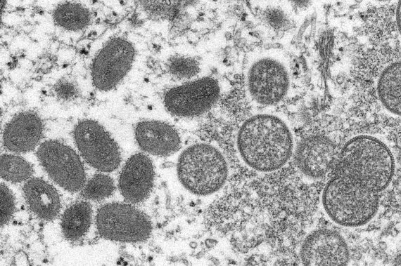 성숙한 타원형의 원숭이두창 바이러스(왼쪽과)와 원모양의 미성숙한 바이러스(오른쪽)가 찍혀 있다. 뉴시스 제공.
