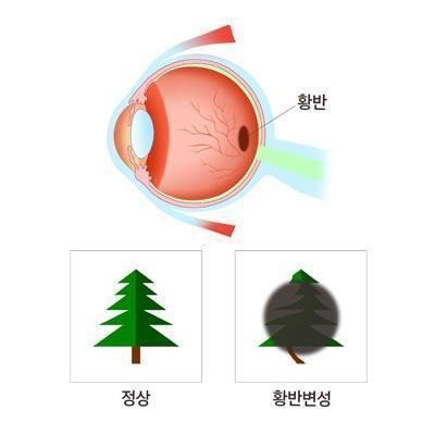 황반변성 있으면 골절 위험 증가한다