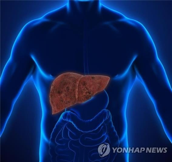 간경변 이미지. 사진=연합뉴스