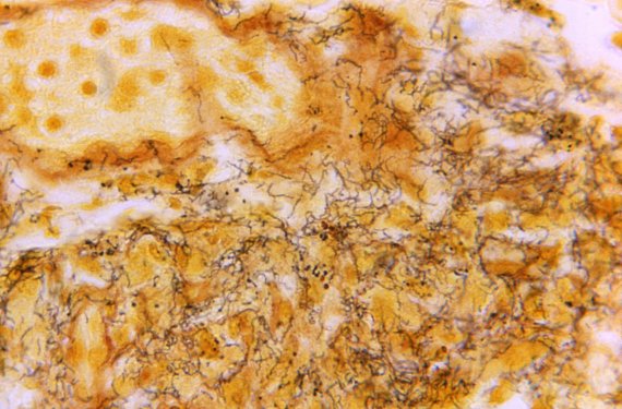 미 질병통제예방센터(CDC)가 제공한 트레포네마 팔리둠 박테리아의 1996년 현미경으로 촬영된 모습. 이 박테리아는 매독을 일으키는 원인이 된다. AP뉴시스