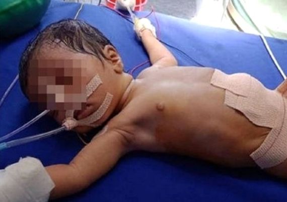 태어난 지 21일 된 신생아의 뱃속에서 8명의 태아가 발견됐다. 출처=NDTV 캡처