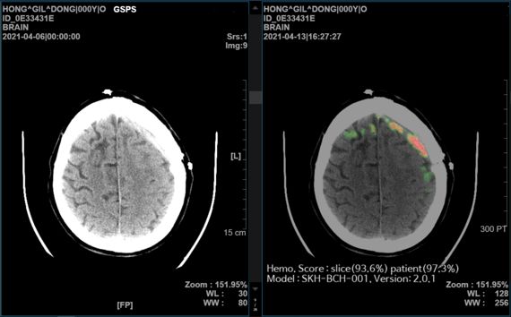 SK㈜ C&C의 AI 뇌출혈 영상 의료 솔루션 '메디컬 인사이트 플러스 뇌출혈' 데모(Demo) 화면. SK㈜ C&C 제공