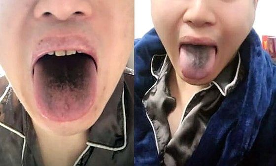 중국 톈진의 한 남성이 코로나19 확진 판정을 받은 뒤 혀가 검게 변했다고 주장하며 사진을 올렸다. 사진=웨이보