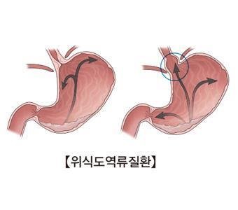 [출처: 서울아산병원]