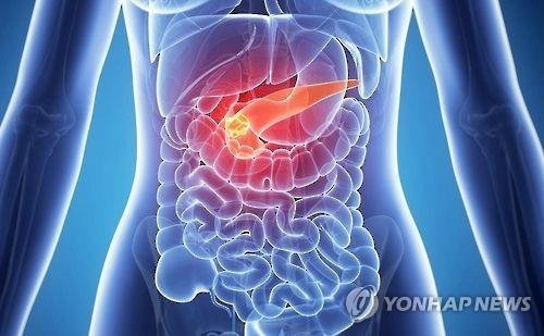 "50살 넘어 당뇨병 발병…췌장암 위험 7.5배 높다"
