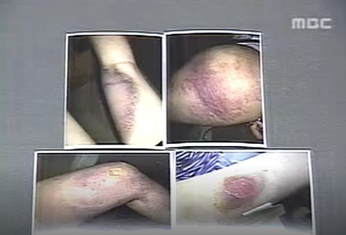 2006년 당시 가해 학생들의 폭행으로 온몸에 피멍이 든 정양의 모습. (MBC 갈무리)