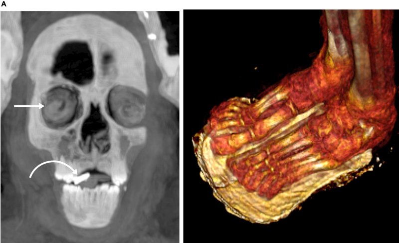[서울=뉴시스] 카이로 대학 연구팀이 CT 촬영한 '황금 혀'와 '하얀 샌들', 고대 이집트인들은 사후 세계에서 대화하기 위해 황금 혀가 필요하며, 망자들이 경건하고 깨끗한 상태를 유지할 수 있도록 하얀색 샌들을 신겨야 한다고 믿었다 (사진출처: Frontiers in Medicine 홈페이지 캡처) 2023.01.25. *재판매 및 DB 금지