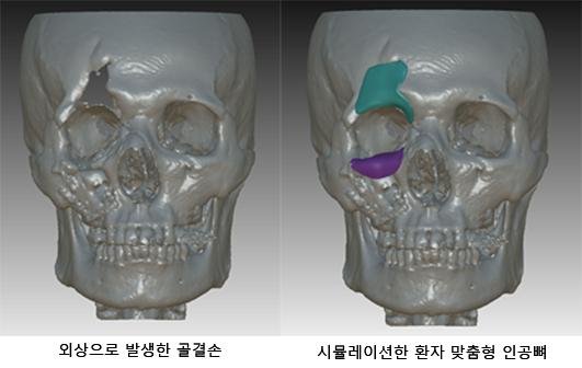 외상으로 발생한 골결손(왼쪽 사진)과 시뮬레이션한 환자 맞춤형 인공뼈 고려대학교의료원 제공