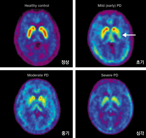 도파체크주사는 신경말단부의 기능 소실을 측정해 이미지로 볼 수 있도록 해주는 진단제다. 사진은 도파체크주사를 이용한 진단 이미지로, 정상부터 초기-중기-심각 단계 상태를 보여주는데 붉은색으로 보이는 도파민성 신경세포가 정상에 비해 줄어든 것을 확인할 수 있다. 듀켐바이오 제공.