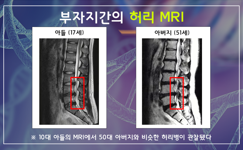 10대 아들의 MRI에서 50대 아버지와 비슷한 허리병이 관찰됐다. 나누리병원 제공