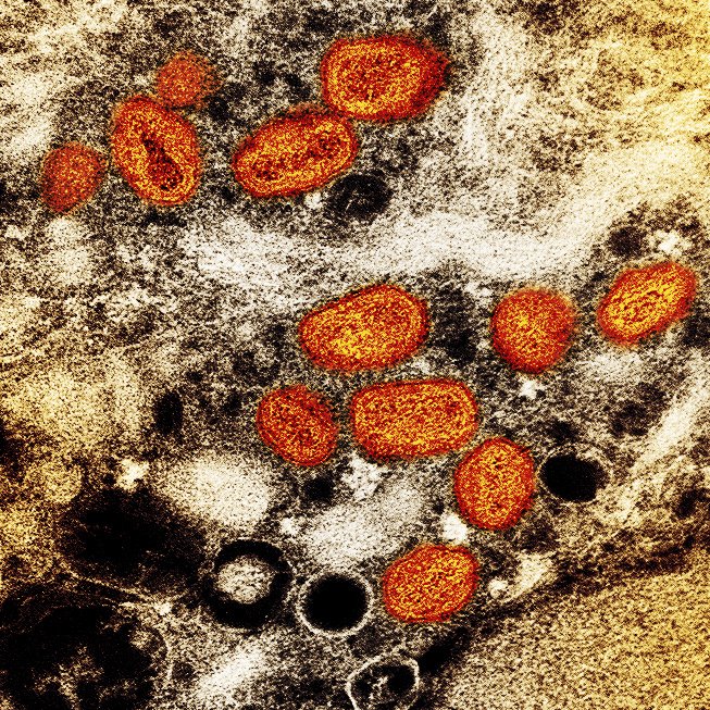 미국 국립알레르기감염병연구소(NIAID)가 투과전자현미경으로 촬영한 실험실에서 배양한 감염된 세포(갈색) 내 원숭이두창 입자(주황색). AP뉴시스