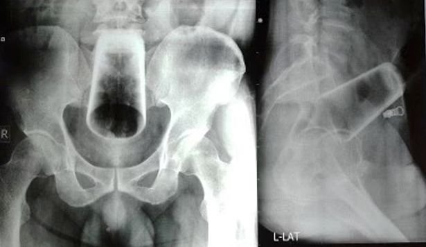 한 네팔 남성이 최근 외과 수술을 통해 장 속에서 12㎝ 길이의 유리컵을 적출했다. /사진=뉴시스
