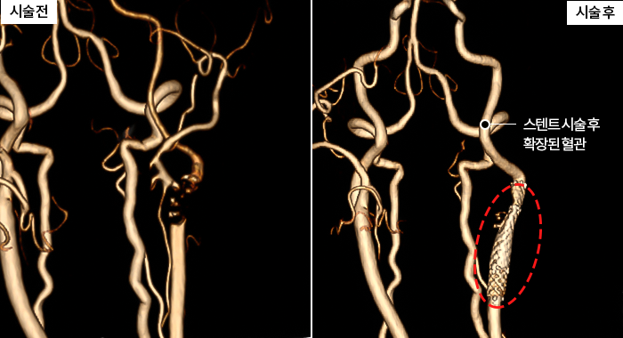 경동맥 협착증 고령환자도 혈관중재술로 치료