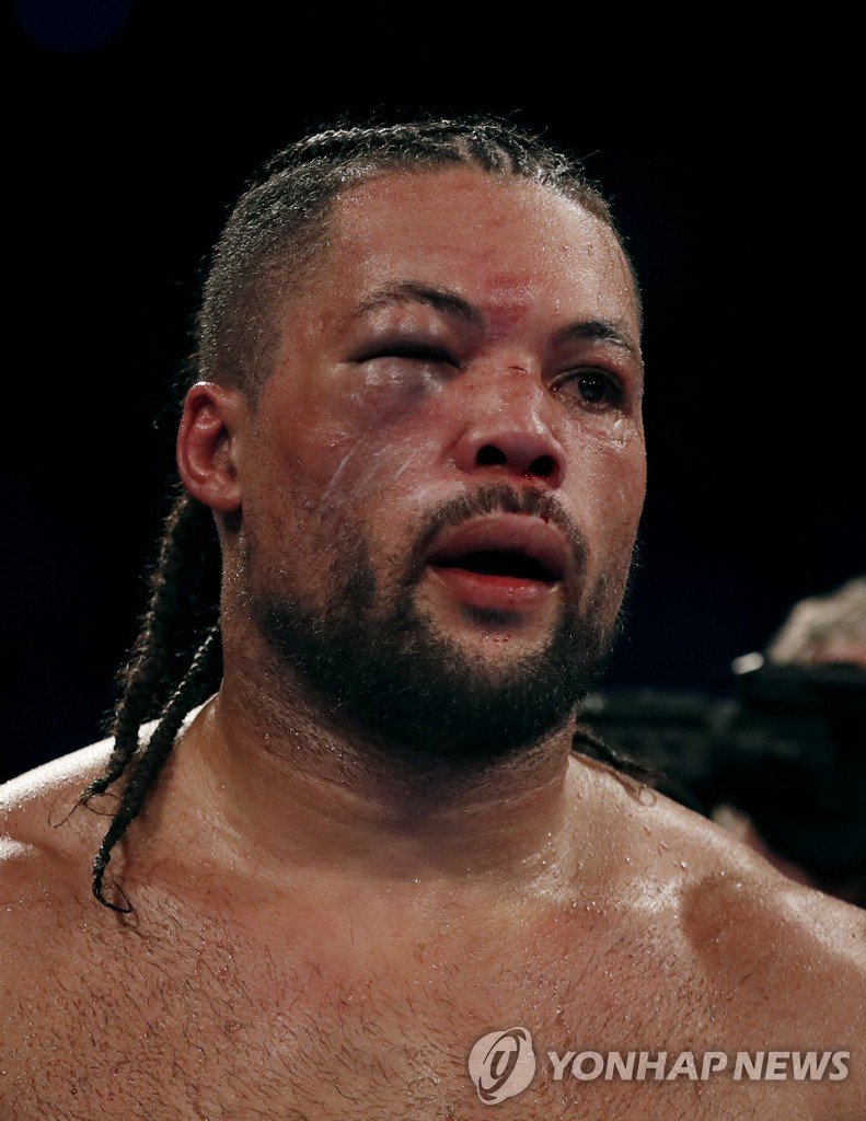 얼굴을 알아볼 수 없게 부어오른 조 조이스 Boxing - WBO Interim World Heavyweight Title - Joe Joyce v Zhilei Zhang - Copper Box Arena, London, Britain - April 15, 2023 Joe Joyce reacts after his fight against Zhilei Zhang was stopped due to his eye injury Action Images via Reuters/Andrew Couldridge