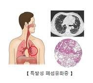 특발성폐섬유화증. 연합뉴스