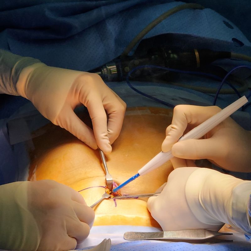 온종합병원, 단일공 복강경 담낭절제술 1700건 돌파