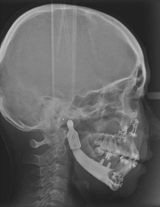 3D프린팅으로 제조된 환자맞춤형 인공 하악골 X레이 사진. 메디쎄이 제공.