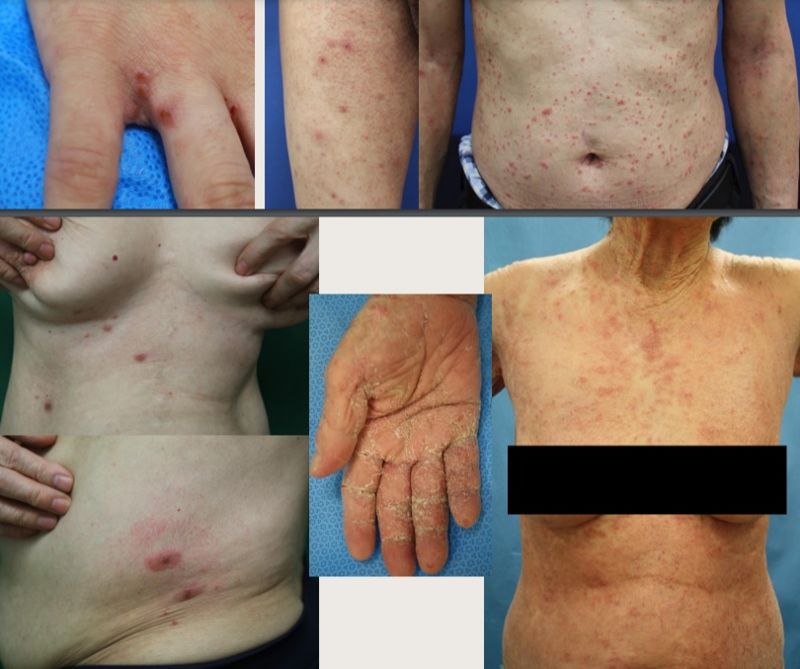 옴 진드기에 감염된 환자들의 사진. 대한피부과학회 제공