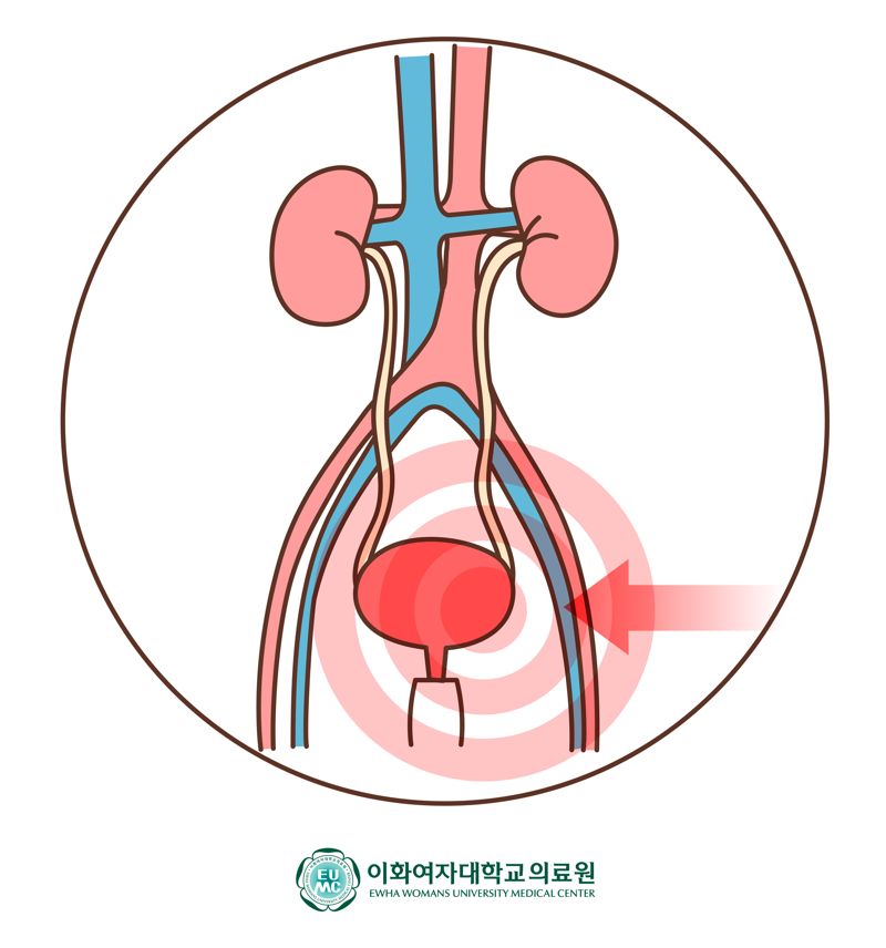 묵직하고 뻐근한 아랫배, 질염인줄 알았더니..