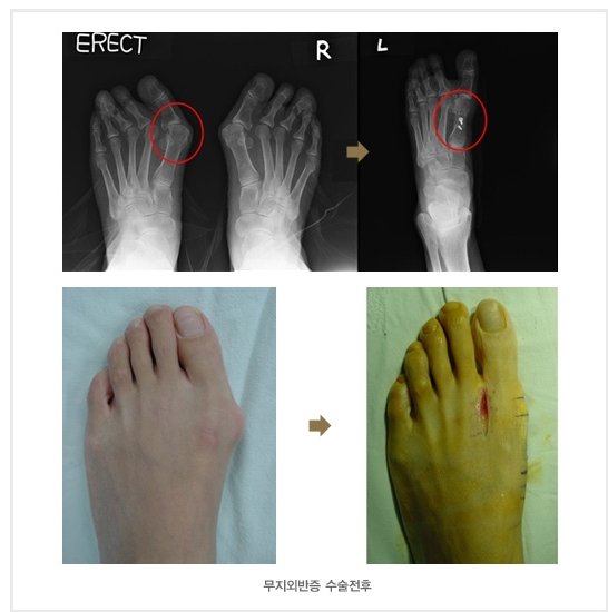 무지외반증 수술 전후 비교 모습(해운대부민병원 제공)