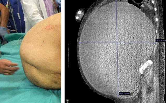 수술 전 여성의 복부(사진 왼쪽)와 컴퓨터단층촬영(CT)검사 사진. 사진=미국 사례 보고 저널