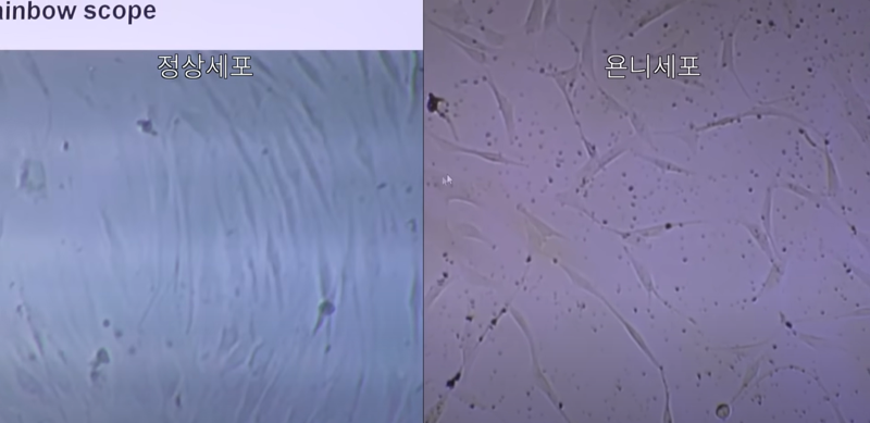 국내 소아조로증 환자 홍원기군(욘니·오른쪽 사진) 세포와 정상 세포. 유튜브 '욘니와치애YonniandChiae' 채널