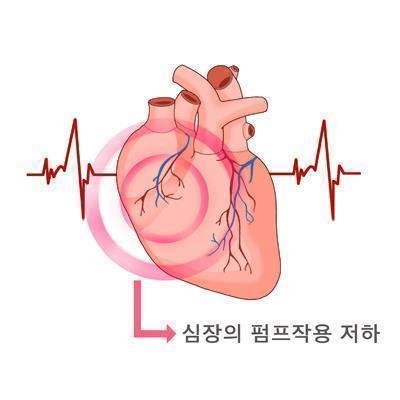 '고령화 시대' 사망률 높은 심부전 환자 급증