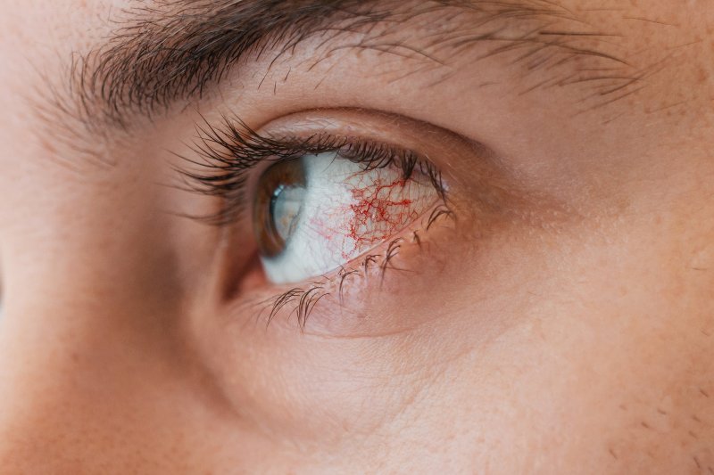 눈이 붉게 충혈되거나 이물감이 느껴지고 눈곱이 점점 많이 끼면 각결막염을 의심해 봐야 한다. 뉴시스