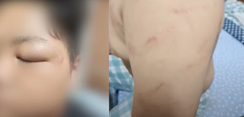 울산에서 또래 여중생들에 폭행 당해 눈과 팔 등에 상처를 입은 남학생의 모습 / MBC 보도화면 갈무리