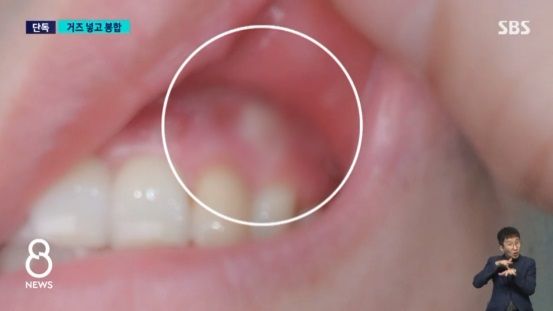 충남 천안의 한 대학교 치과병원에서 수술 받은 환자의 잇몸에서 거즈가 발견됐다. 출처=SBS방송 캡처